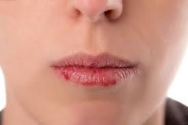 Что необходимо делать, если очень сильно трескаются губы?