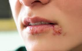 Чем так коварен герпес?