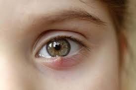 Какие причины появления ячменя на глазу?