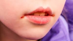 Какие причины появления заед (ангулита) вокруг уголков рта?