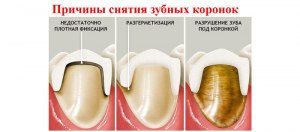 Как снять боль, если болит десна у зуба под коронкой?