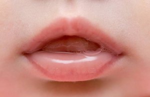 Может ли слюна вызывать аллергическую реакцию при поцелуях?