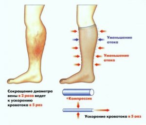 Чем опасны отеки ног?