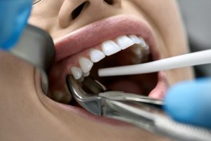 Что говорят стоматологи при удалении нескольких зубов, сколько можно сразу?