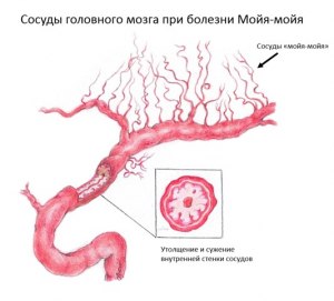 Каковы причины тридемии?