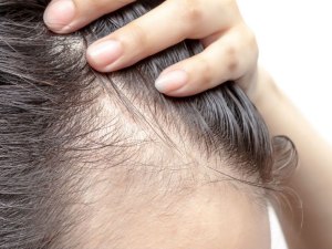 Почему из-за стресса выпадают волосы и что с этим делать?