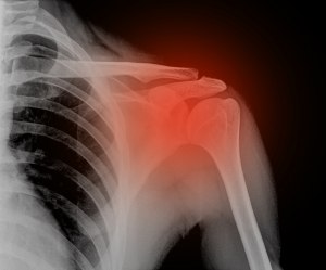 Что включает в себя реабилитация после осколочного перелома плеча?