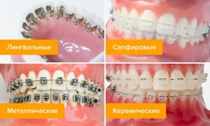 Нужно ли лечить зубы, чтобы установить брекеты?