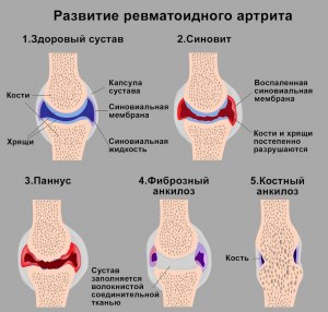 Чем отличается ревматоидный артрит от полиартрита?