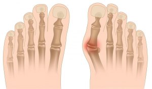 Существует ли безоперационное лечение "косточек" на ногах (Hallux valgus)?