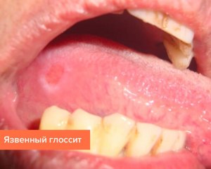 Как долго заживают травмы языка?