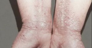 Какие существуют нетрадиционные методы лечения нейродермита?