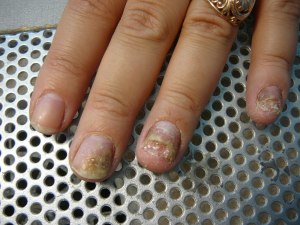 Какие есть заболевания ногтей на руках и чем их вылечить?