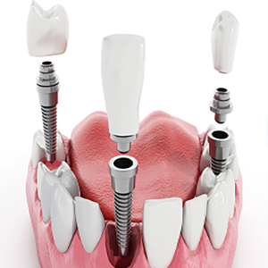 Как выбрать зубной имплантат?