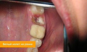 Болит десна через месяц после удаления зуба: что делать?