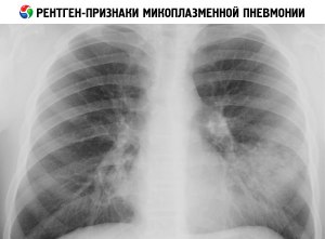 Что известно о заболевании микоплазменная пневмония? Как и чем лечить?