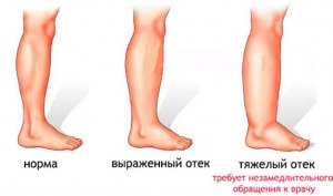 Есть ли смысл обращаться к гомеопату, если отекают ноги?