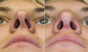 Помогает ли операция по исправлению носовой перегородки лазером?