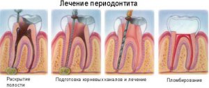 Почему надо обязательно удалять зуб при периодонтите?