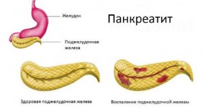 "Холод голод и покой" - от панкреатита? От чего ещё этот "рецепт здоровья"?