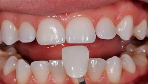 Как правильно ухаживать за ортодонтическими мини-винтами?
