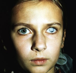 Если удалили один глаз, положена ли инвалидность?