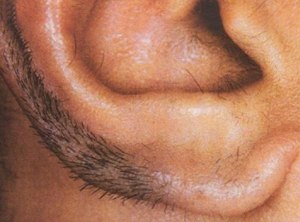 Гипертрихоз поддаётся лечению?