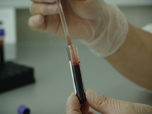 Как без анализов определить, что кровь слишком густая?