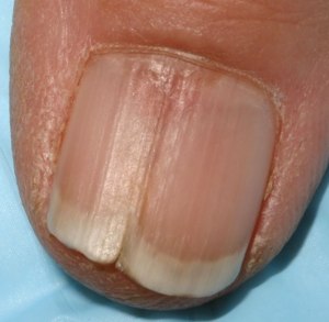 Сколько стоит лечение дистрофии ногтей в частной клинике?