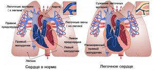 Что такое лежачее сердце, какие симптомы, какое лечение?