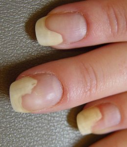 В чём причина дистрофии ногтя?