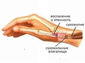 Воспаление сухожилия на руке, как лечить?