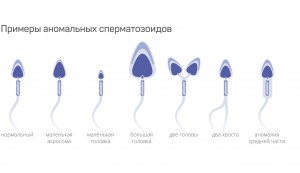 Аномалии сперматозоидов. Что Вы об этом знаете? Есть ли опыт лечения?