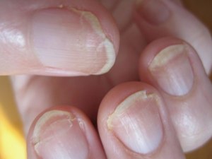 Как визуально отличить дистрофию ногтя от онихомикоза?