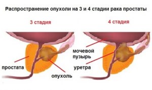 Почему у жителей Юго-Восточной Азии реже встречается рак простаты?