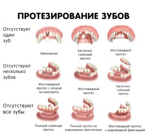 Какие бюджетные виды зубного протезирования существуют?