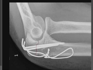 В каком случае при переломе устанавливаются спицы?