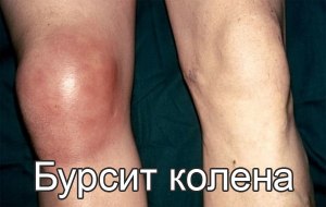 Бурсит суставной сумки НЧВС как лечить?