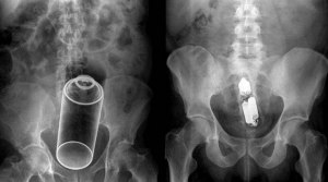 Будет ли эффект от ректальной свечи, если прямая кишка не опорожнена?