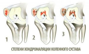 Что такое хондромаляция надколенника?