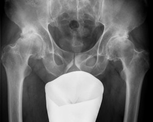 При рентгене тазобедренного сустава не прикрывают половые органы защитой?