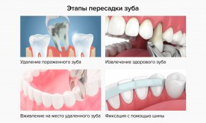 Используется ли в стоматологии трансплантация зубов и сколько она стоит?
