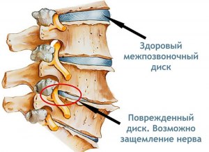 Какая связь появления грыжи на позвоночнике и похудением?