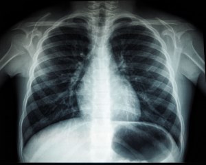 Рентгенография органов грудной клетки это и есть ФЛГ?