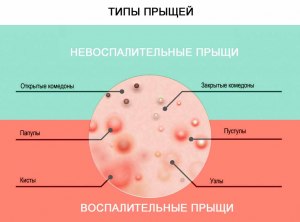 Проблема с кожей в виде прыщей может быть связана с уровнем тестостерона?