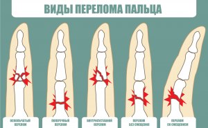 Какой из переломов части пальца срастается дольше?