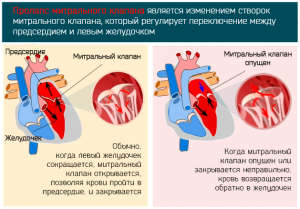 Пролапс митрального клапана сердца можно вылечить? Как?