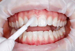 Реально ли фторирование зубов предотвращает появление кариеса?