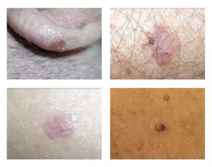 Правда ли, что загар вызывает рак кожи?