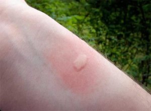 Почему у ребёнка при укусе комара сильно отекает место укуса?